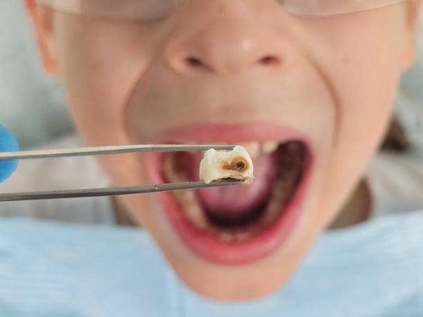 Best Emergency Tooth Extraction in Lake Mills, IA